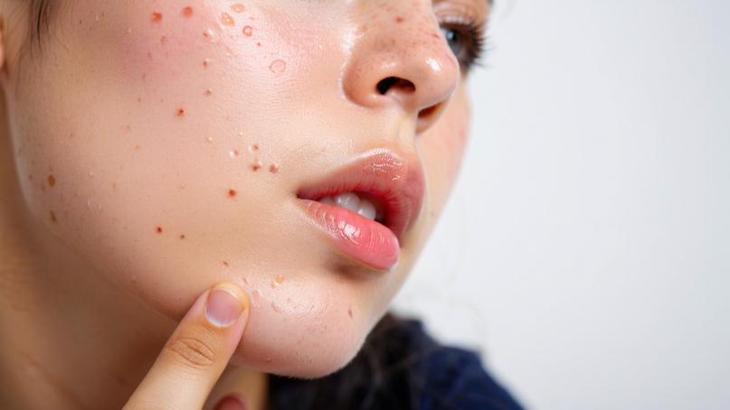 脸上频繁长痘?可能与这4个原因有关，尽量避免!