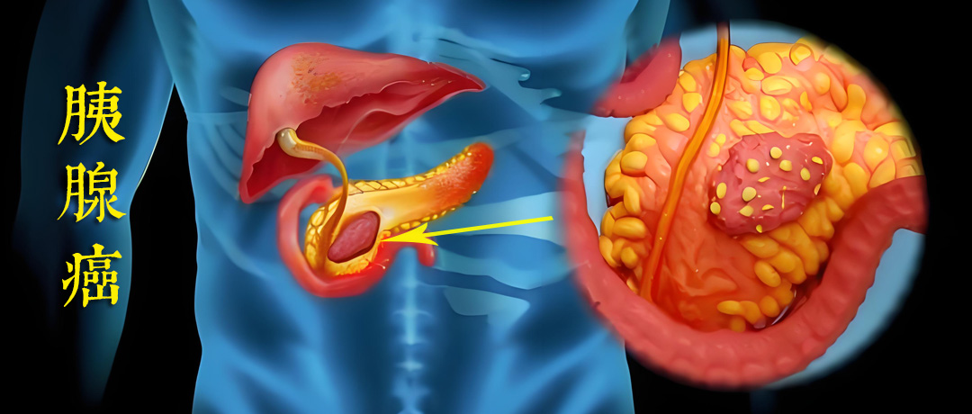 胰腺癌早期难发现?这7个微妙症状最容易被忽略