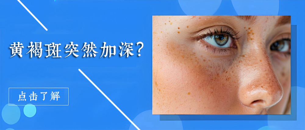 黄褐斑突然加深?可能与这5个内因有关