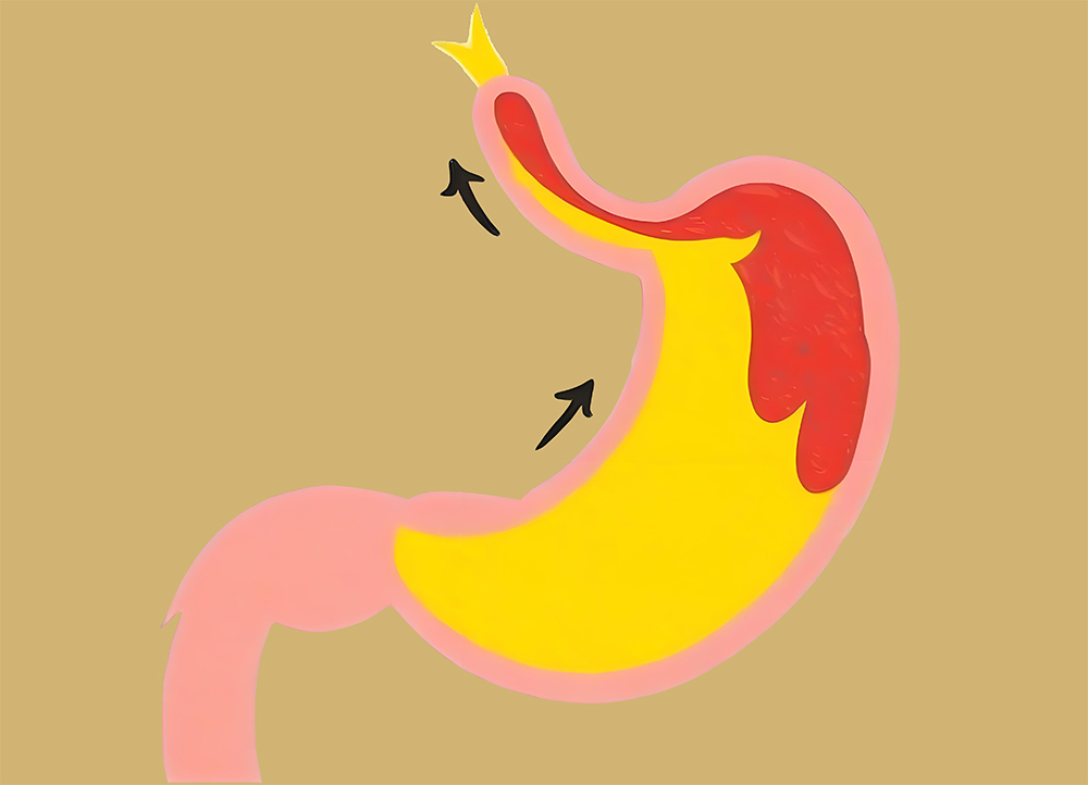 胃食管反流痛苦难忍?睡前3小时牢记“三不原则”