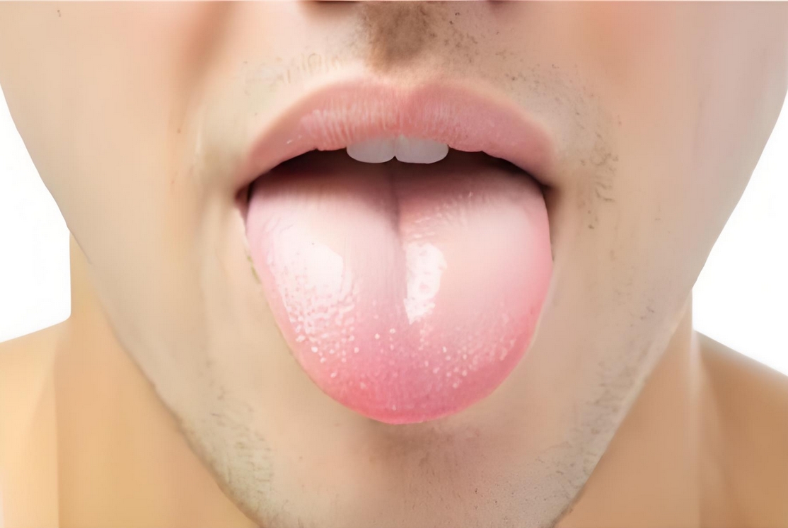 舌苔异常厚白?别光刷牙，可能是6种内湿的表现