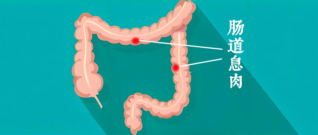 便血颜色暗红?肠息肉恶变的4个危险信号