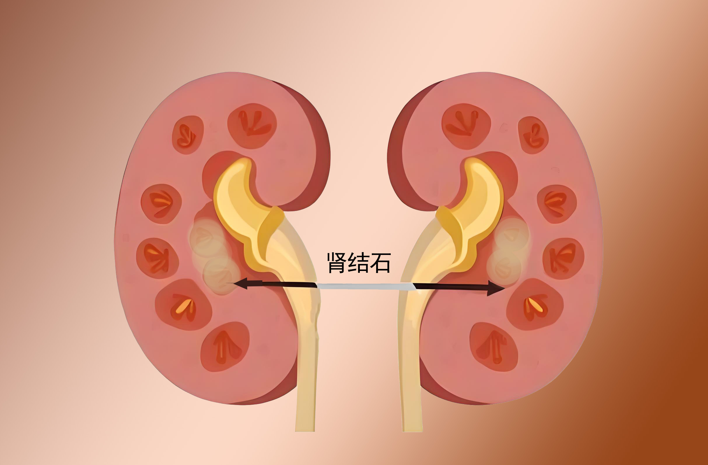肾结石的5个预警信号，腰部绞痛速就医