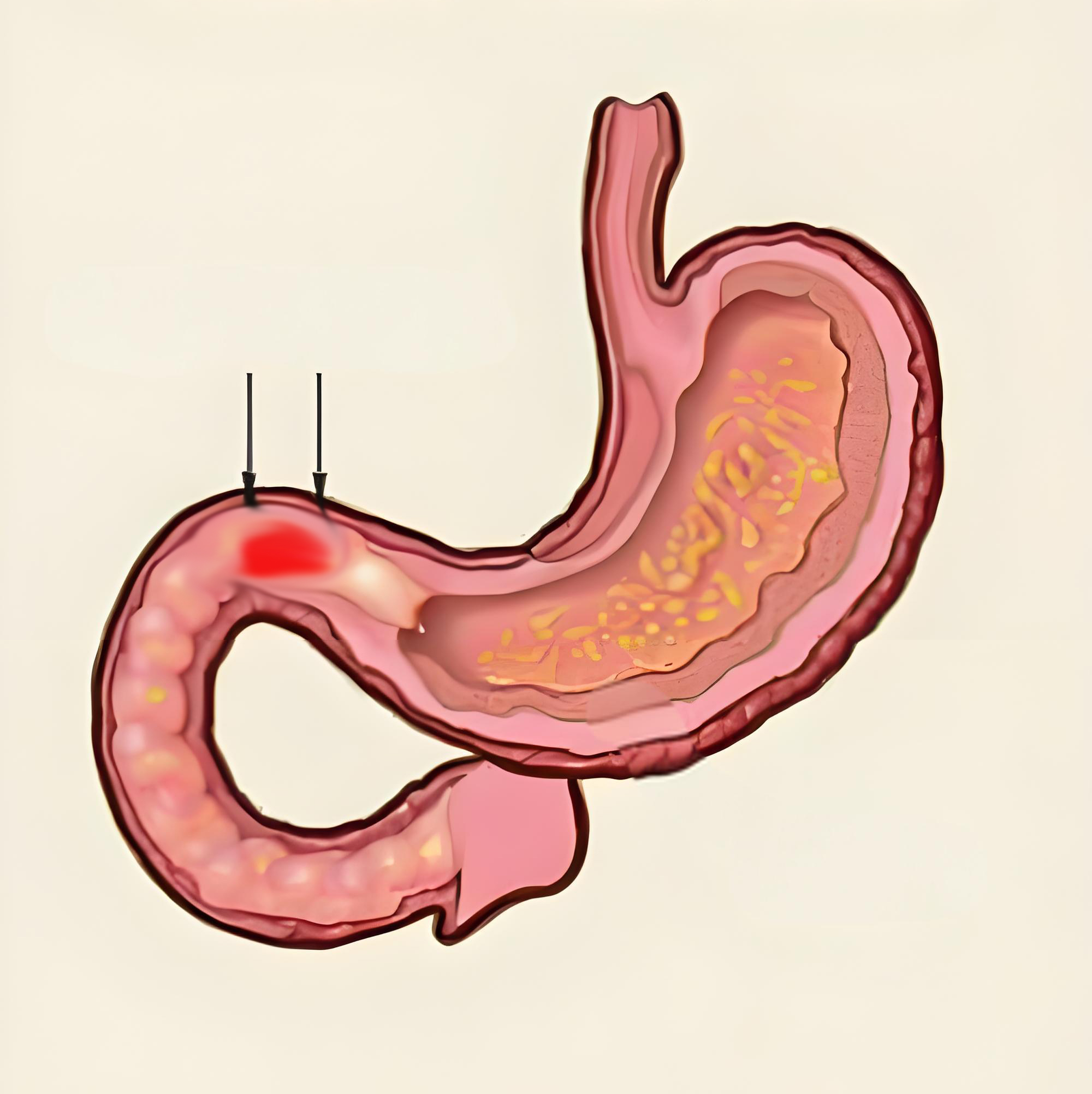 十二指肠溃疡别忽视!这2个并发症很危险